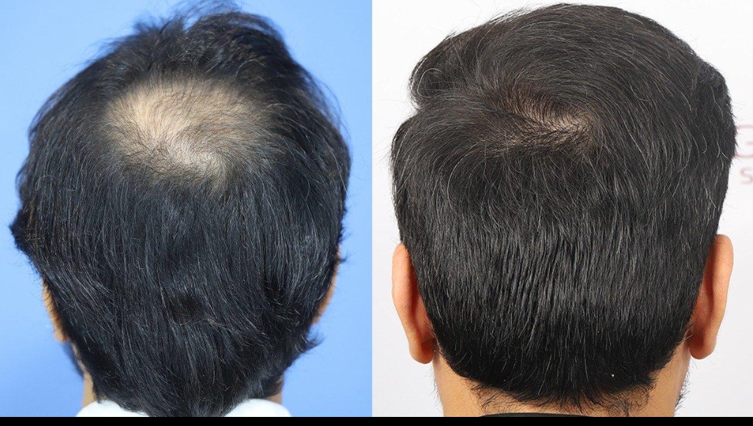 Small Crown Hair Transplant