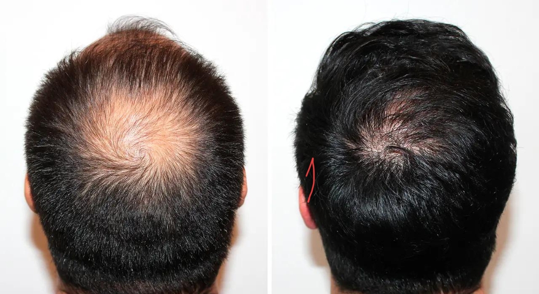 Medium Crown Hair Transplant