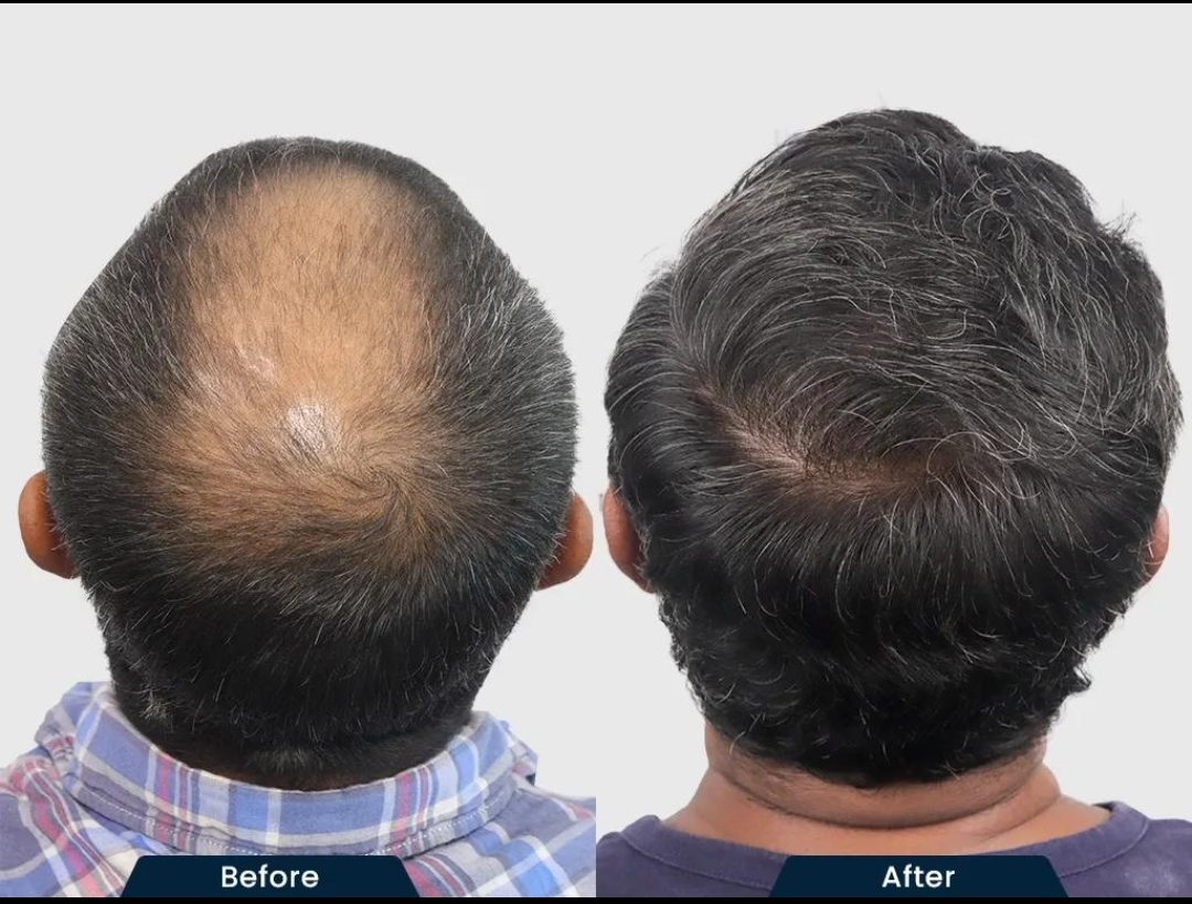 Large Crown Hair Transplant