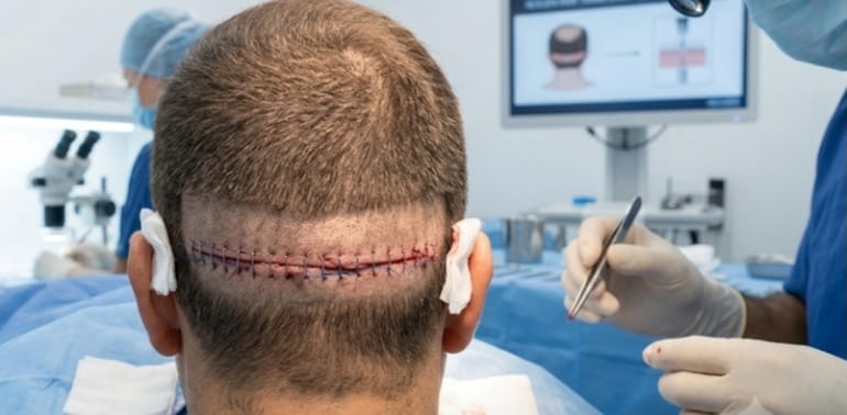 FUT Hair Transplant in India