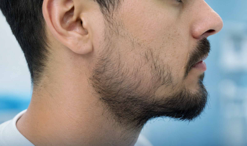 Beard & Facial Hair Restoration