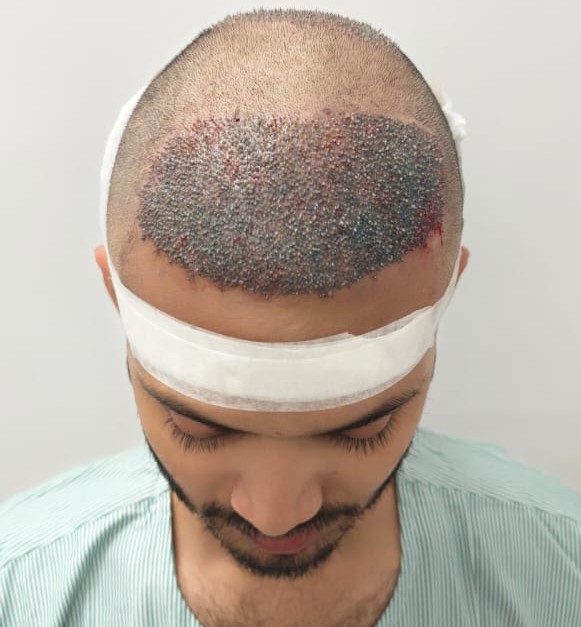 Post Surgery Support for Post-Surgery Support for Crown Hair Transplant
